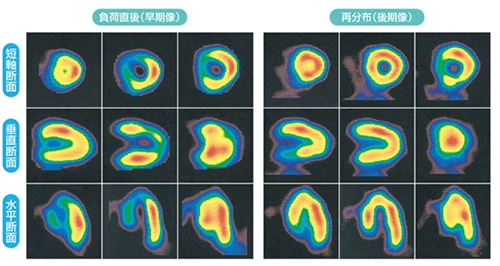 心臓核医学検査(心筋シンチグラム)