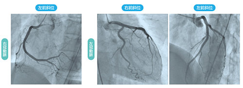 冠動脈造影検査の画像