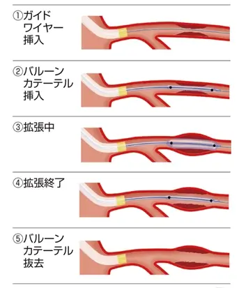 バルーン治療