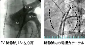 心房細動の発生の様子