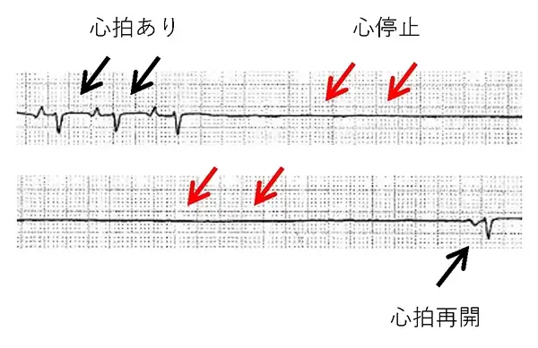図2　洞不全による７秒の心停止