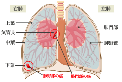 肺がんの図