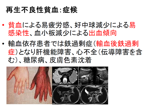 再生不良性貧血 症候
