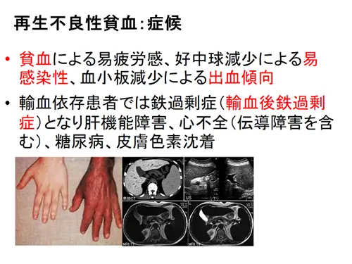再生不良性貧血 症候