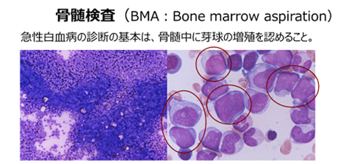 急性 骨髄 性 白血病