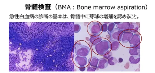 骨髄検査で調べること