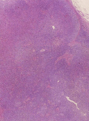びまん性大細胞型B細胞リンパ腫