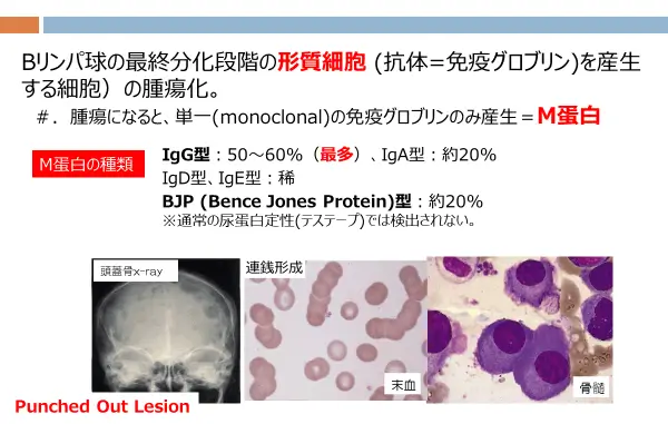 Bリンパ球の最終分化段階の形質細胞の腫瘍化