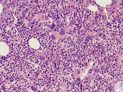 血栓増加症の原因は何ですか?