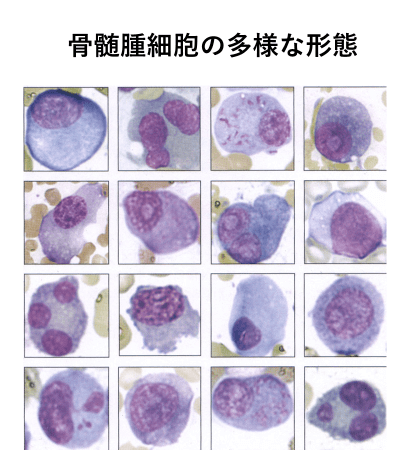 多種多様な骨髄腫の細胞形態