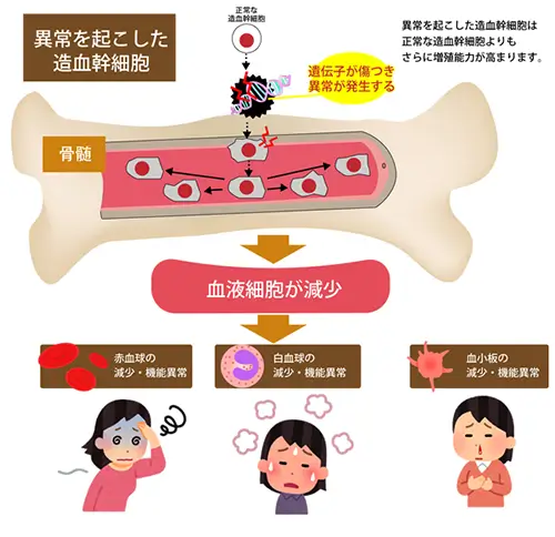 骨髄異形成症候群の症状