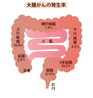 大腸がんの発生率