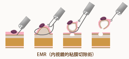 内視鏡治療