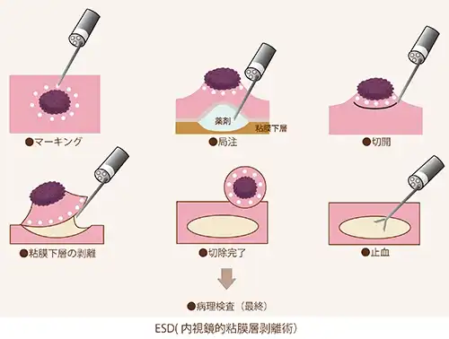 内視鏡治療