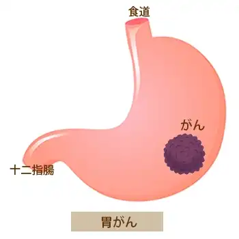 胃がんイメージ