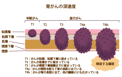 胃壁の構造と胃がんの深達度