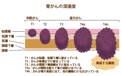 胃壁の構造と胃がんの深達度