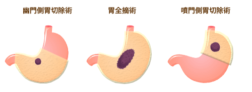 外科治療(手術)