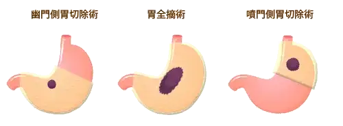 外科治療(手術)