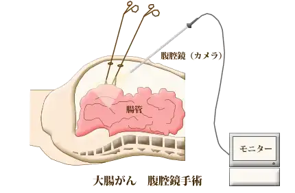 腹腔鏡手術