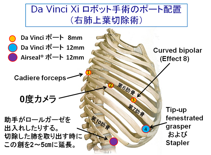 Da Vinci Xi ロボット手術のポート配置