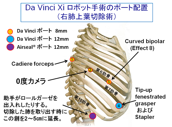 手術について 呼吸器外科 新百合ヶ丘総合病院