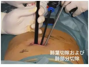 単孔式手術