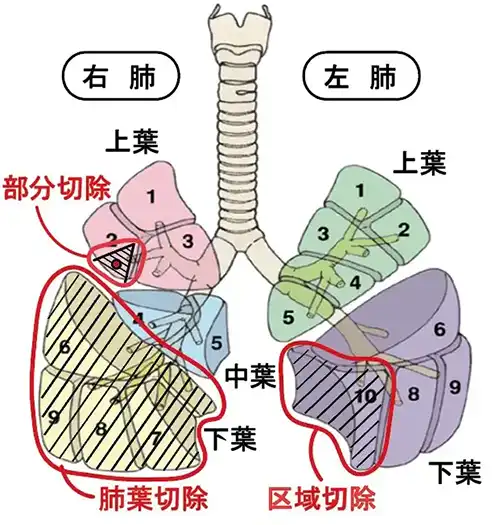 肺の手術イラスト
