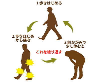 歩行最初から痛い、前屈みで改善：脊柱管狭窄症