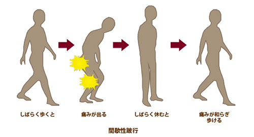 歩行したら痛い:閉塞性動脈硬化症