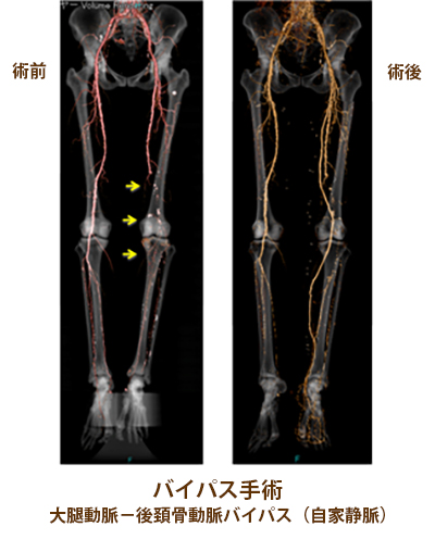 間欠性跛行に対する大腿の血管内治療