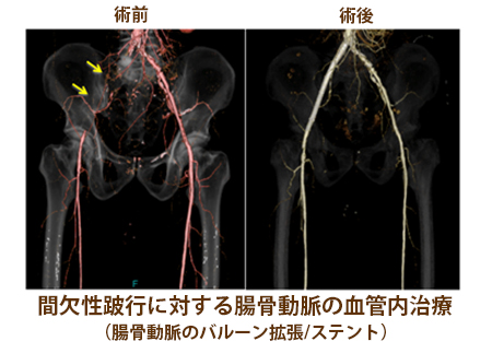 間欠性跛行に対する腸骨動脈の血管内治療