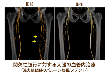 間欠性跛行に対する大腿の血管内治療