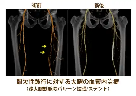 間欠性跛行に対する大腿の血管内治療