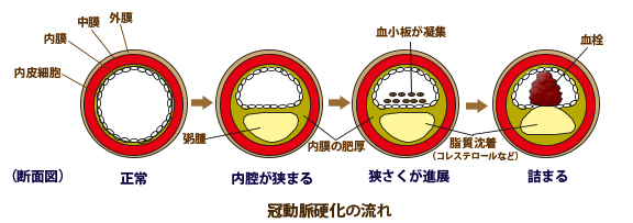 動脈硬化02