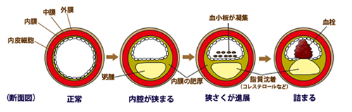 図1) 動脈硬化が進行する流れ