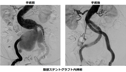 腹部大動脈瘤治療用のステントグラフト治療の実際