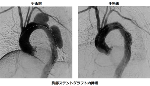 胸部大動脈瘤のステントグラフト治療の実際