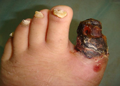 図2) 第四期の患者さんの足、左足の親指が壊死している。