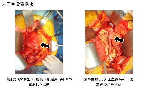 人工血管置換術