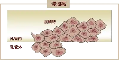 浸潤がん