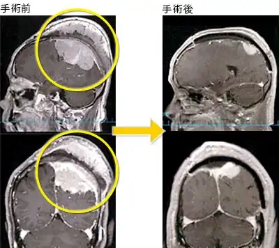 髄膜腫1.左頭頂部髄膜腫