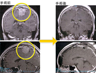 髄膜腫-2 左傍矢状洞髄膜腫