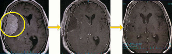 髄膜腫-5 右大脳円蓋部髄膜腫
