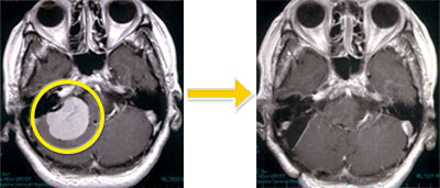 髄膜腫-7 右小脳橋角部髄膜腫