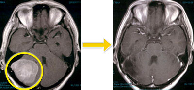 髄膜腫-8 右小脳円蓋部髄膜腫