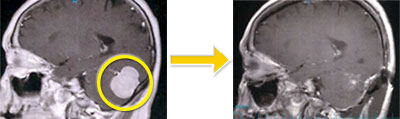 髄膜腫-9 小脳テント髄膜腫
