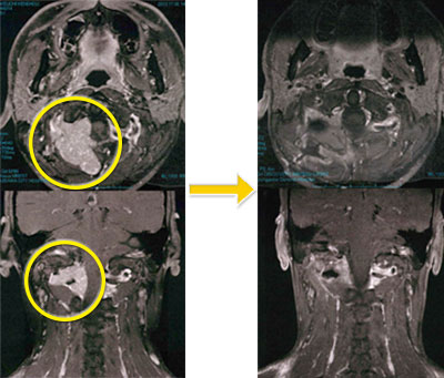 髄膜腫-12 頚部髄膜腫