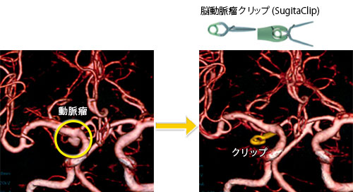 未破裂脳動脈瘤-1 右内頚動脈-後交通動脈分岐部動脈瘤