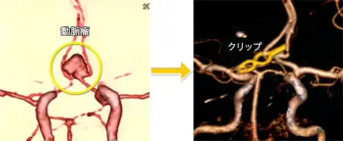 破裂脳動脈瘤(くも膜下出血)-1 前交通動脈瘤